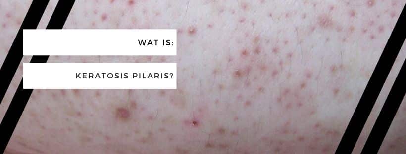 Wat is keratosis pilaris?